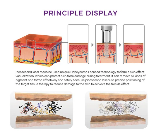 Ultrapulse CO2 Fractional Laser Ultrapulse CO2 Fractional Laser